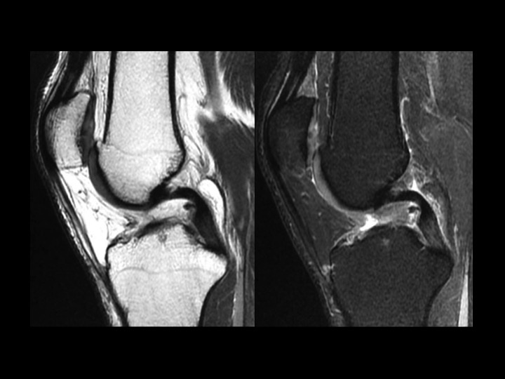 Figure 2 for case posteromedial bundle of posterior cruciate ligament ( RID2786 )